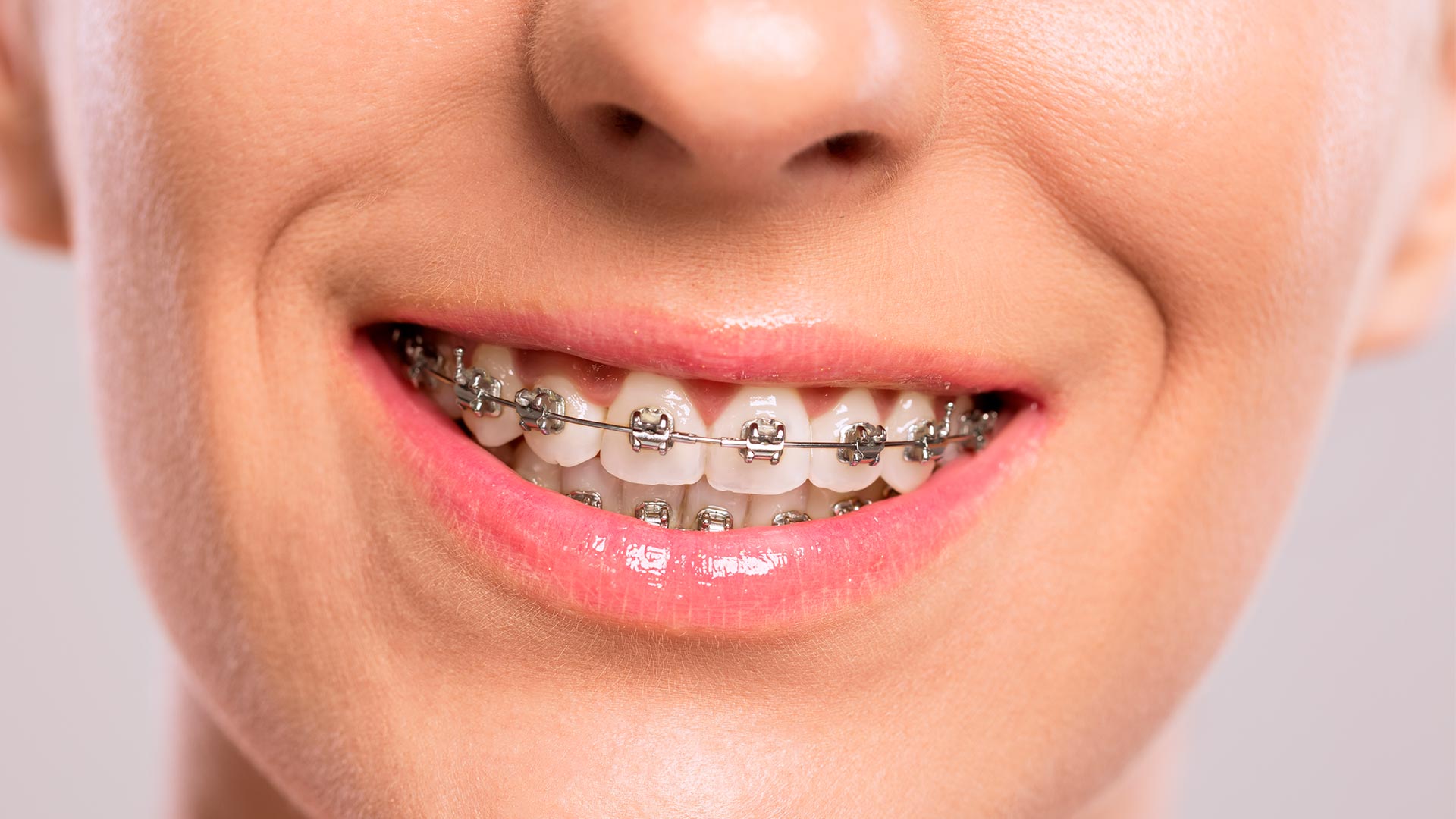 What About Coverage for Braces? | Get a Free Health ...